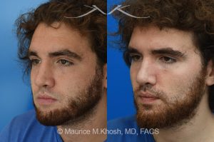 Photo of a patient before and after a procedure. Revision rhinoplasty with ear cartilage graft and osteotomies - This 26 year-old had previously undergone rhinoplasty which resulted in over-resection of the nasal bridge and excess width of the bony nasal dorsum. He underwent revision rhinoplasty in Manhattan by us. Ear cartilage was used to augment the height of the nasal bridge. The nasal bones were broken and moved closer to each other, to narrow the bridge. He is ecstatic with his revision rhinoplasty results. 