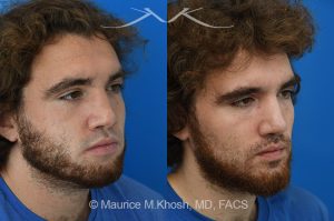 Photo of a patient before and after a procedure. Revision rhinoplasty with ear cartilage graft and osteotomies - This 26 year-old had previously undergone rhinoplasty which resulted in over-resection of the nasal bridge and excess width of the bony nasal dorsum. He underwent revision rhinoplasty in Manhattan by us. Ear cartilage was used to augment the height of the nasal bridge. The nasal bones were broken and moved closer to each other, to narrow the bridge. He is ecstatic with his revision rhinoplasty results. 
