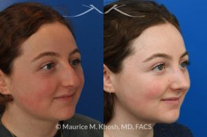 Photo of a patient before and after a procedure. Rhinoplasty for droopy tip and nasal hump - This delightful 18 year old was not happy with the external appearance of her nose. She disliked the nasal hump, the droopy tip, and the ''unrefined'' shape of her nose. She underwent an open approach rhinoplasty in New York. The dorsal height was reduced, the nasal tip was elevated, and the tip was narrowed and refined. The post op pictures show her at 2 years post op. She is ecstatic with the outcome of her rhinoplasty.