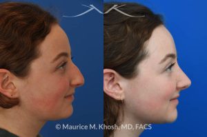 Photo of a patient before and after a procedure. Rhinoplasty for droopy tip and nasal hump - This delightful 18 year old was not happy with the external appearance of her nose. She disliked the nasal hump, the droopy tip, and the ''unrefined'' shape of her nose. She underwent an open approach rhinoplasty in New York. The dorsal height was reduced, the nasal tip was elevated, and the tip was narrowed and refined. The post op pictures show her at 2 years post op. She is ecstatic with the outcome of her rhinoplasty.