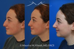 Photo of a patient before and after a procedure. Rhinoplasty for droopy tip and nasal hump. The left picture shows the before, the center picture shows the computer simulation, and the right one shows the post op result. - This delightful 18 year old was not happy with the external appearance of her nose. She disliked the nasal hump, the droopy tip, and the ''unrefined'' shape of her nose. She underwent an open approach rhinoplasty in New York. The dorsal height was reduced, the nasal tip was elevated, and the tip was narrowed and refined. The post op pictures show her at 2 years post op. She is ecstatic with the outcome of her rhinoplasty.