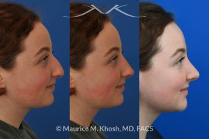 Photo of a patient before and after a procedure. Rhinoplasty for droopy tip and nasal hump. The left picture shows the before, the center picture shows the computer simulation, and the right one shows the post op result. - This delightful 18 year old was not happy with the external appearance of her nose. She disliked the nasal hump, the droopy tip, and the ''unrefined'' shape of her nose. She underwent an open approach rhinoplasty in New York. The dorsal height was reduced, the nasal tip was elevated, and the tip was narrowed and refined. The post op pictures show her at 2 years post op. She is ecstatic with the outcome of her rhinoplasty.