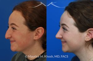 Photo of a patient before and after a procedure. Rhinoplasty for droopy tip and nasal hump - This delightful 18 year old was not happy with the external appearance of her nose. She disliked the nasal hump, the droopy tip, and the ''unrefined'' shape of her nose. She underwent an open approach rhinoplasty in New York. The dorsal height was reduced, the nasal tip was elevated, and the tip was narrowed and refined. The post op pictures show her at 2 years post op. She is ecstatic with the outcome of her rhinoplasty.