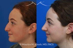 Photo of a patient before and after a procedure. Rhinoplasty for droopy tip and nasal hump - This delightful 18 year old was not happy with the external appearance of her nose. She disliked the nasal hump, the droopy tip, and the ''unrefined'' shape of her nose. She underwent an open approach rhinoplasty in New York. The dorsal height was reduced, the nasal tip was elevated, and the tip was narrowed and refined. The post op pictures show her at 2 years post op. She is ecstatic with the outcome of her rhinoplasty.