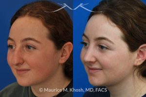 Photo of a patient before and after a procedure. Rhinoplasty for droopy tip and nasal hump - This delightful 18 year old was not happy with the external appearance of her nose. She disliked the nasal hump, the droopy tip, and the ''unrefined'' shape of her nose. She underwent an open approach rhinoplasty in New York. The dorsal height was reduced, the nasal tip was elevated, and the tip was narrowed and refined. The post op pictures show her at 2 years post op. She is ecstatic with the outcome of her rhinoplasty.