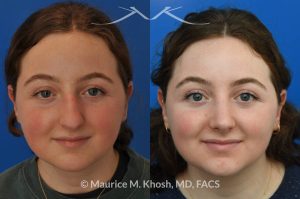 Photo of a patient before and after a procedure. Rhinoplasty for droopy tip and nasal hump - This delightful 18 year old was not happy with the external appearance of her nose. She disliked the nasal hump, the droopy tip, and the ''unrefined'' shape of her nose. She underwent an open approach rhinoplasty in New York. The dorsal height was reduced, the nasal tip was elevated, and the tip was narrowed and refined. The post op pictures show her at 2 years post op. She is ecstatic with the outcome of her rhinoplasty.