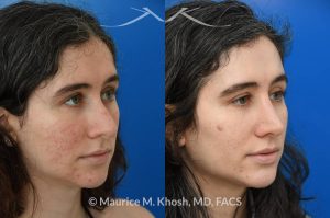 Photo of a patient before and after a procedure. Rhinoplasty for droopy tip and small hump - Patient sought septoplasty and rhinoplasty in our Manhattan office to address chronic nasal obstruction, deviated appearing bridge, a small dorsal hump, and sagging nasal tip. Surgery was performed through a closed approach (endo-nasal approach). The results show the one year result. She is ecstatic with the breathing and aesthetic results.