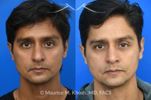 Photo of a patient before and after a procedure. Rhinoplasty  - Rhinoplasty was performed through the open approach to reduce the nasal hump (radix graft as well as dorsal shave), elevate the tip (septo-columellar sutures), and refine the lower nose (alar strut grafts and cephalic trimming). The patient is ecstatic about the final outcome which is completely natural and perfectly complementary to his face. 