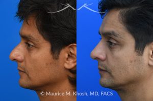 Photo of a patient before and after a procedure. Rhinoplasty  - Rhinoplasty was performed through the open approach to reduce the nasal hump (radix graft as well as dorsal shave), elevate the tip (septo-columellar sutures), and refine the lower nose (alar strut grafts and cephalic trimming). The patient is ecstatic about the final outcome which is completely natural and perfectly complementary to his face. 