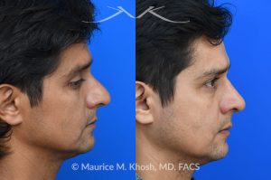 Photo of a patient before and after a procedure. Rhinoplasty  - Rhinoplasty was performed through the open approach to reduce the nasal hump (radix graft as well as dorsal shave), elevate the tip (septo-columellar sutures), and refine the lower nose (alar strut grafts and cephalic trimming). The patient is ecstatic about the final outcome which is completely natural and perfectly complementary to his face. 