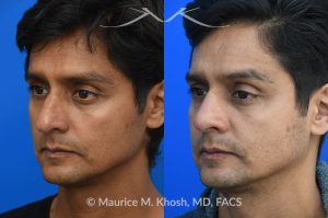 Photo of a patient before and after a procedure. Rhinoplasty  - Rhinoplasty was performed through the open approach to reduce the nasal hump (radix graft as well as dorsal shave), elevate the tip (septo-columellar sutures), and refine the lower nose (alar strut grafts and cephalic trimming). The patient is ecstatic about the final outcome which is completely natural and perfectly complementary to his face. 