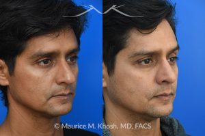 Photo of a patient before and after a procedure. Rhinoplasty  - Rhinoplasty was performed through the open approach to reduce the nasal hump (radix graft as well as dorsal shave), elevate the tip (septo-columellar sutures), and refine the lower nose (alar strut grafts and cephalic trimming). The patient is ecstatic about the final outcome which is completely natural and perfectly complementary to his face. 