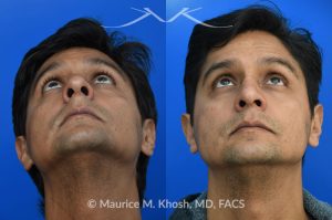 Photo of a patient before and after a procedure. Rhinoplasty  - Rhinoplasty was performed through the open approach to reduce the nasal hump (radix graft as well as dorsal shave), elevate the tip (septo-columellar sutures), and refine the lower nose (alar strut grafts and cephalic trimming). The patient is ecstatic about the final outcome which is completely natural and perfectly complementary to his face. 