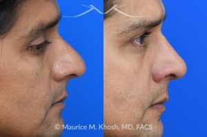 Photo of a patient before and after a procedure. Rhinoplasty  - Rhinoplasty was performed through the open approach to reduce the nasal hump (radix graft as well as dorsal shave), elevate the tip (septo-columellar sutures), and refine the lower nose (alar strut grafts and cephalic trimming). The patient is ecstatic about the final outcome which is completely natural and perfectly complementary to his face. 