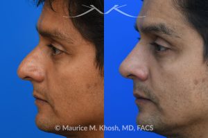 Photo of a patient before and after a procedure. Rhinoplasty  - Rhinoplasty was performed through the open approach to reduce the nasal hump (radix graft as well as dorsal shave), elevate the tip (septo-columellar sutures), and refine the lower nose (alar strut grafts and cephalic trimming). The patient is ecstatic about the final outcome which is completely natural and perfectly complementary to his face. 