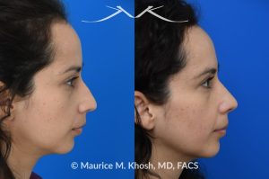 Photo of a patient before and after a procedure. Subtle rhinoplasty to elevate tip and improve dorsal hump - This lovely patient sought rhinoplasty consultation to achieve a subtle alteration in the shape of her nose. She wanted a slight lift of her nasal tip and reduction of the dorsal hump. She did not wish to have a significant change or an unnatural result. As you can see in the last two images in this series, the simulation results shown in the middle photos match the final results fairly closely. She is ecstatic with her results.