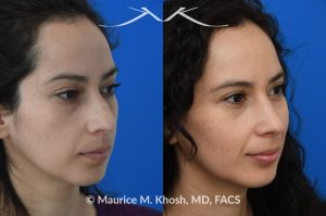 Photo of a patient before and after a procedure. Subtle rhinoplasty to elevate tip and improve dorsal hump - This lovely patient sought rhinoplasty consultation to achieve a subtle alteration in the shape of her nose. She wanted a slight lift of her nasal tip and reduction of the dorsal hump. She did not wish to have a significant change or an unnatural result. As you can see in the last two images in this series, the simulation results shown in the middle photos match the final results fairly closely. She is ecstatic with her results.