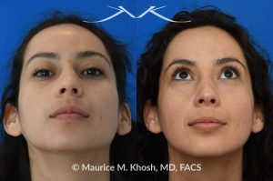 Photo of a patient before and after a procedure. Subtle rhinoplasty to elevate tip and improve dorsal hump - This lovely patient sought rhinoplasty consultation to achieve a subtle alteration in the shape of her nose. She wanted a slight lift of her nasal tip and reduction of the dorsal hump. She did not wish to have a significant change or an unnatural result. As you can see in the last two images in this series, the simulation results shown in the middle photos match the final results fairly closely. She is ecstatic with her results.