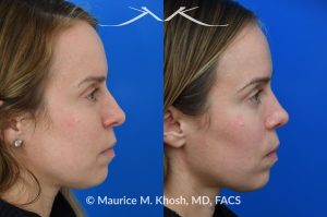 Photo of a patient before and after a procedure. Nasal hump reduction and tip narrow - This young lady had septum deviation which affected her breathing and caused asymmetry of her nostrils. She wanted to smooth a small nasal hump and narrow her tip in a conservative manner. The last two images show her pre op profile (on the left), the computer simulation (in the middle), and the final results (on the right). 