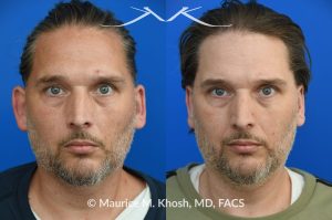 Photo of a patient before and after a procedure. Otoplasty - This gentleman was interested in ear pinning to correct over-projected ears. He underwent otoplasty under local anesthesia in our Manhattan office. He is delighted with the improved shape of his ears. 