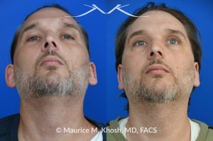 Photo of a patient before and after a procedure. Otoplasty - This gentleman was interested in ear pinning to correct over-projected ears. He underwent otoplasty under local anesthesia in our Manhattan office. He is delighted with the improved shape of his ears. 