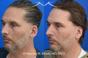 Photo of a patient before and after a procedure. Otoplasty - This gentleman was interested in ear pinning to correct over-projected ears. He underwent otoplasty under local anesthesia in our Manhattan office. He is delighted with the improved shape of his ears. 