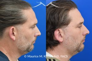 Photo of a patient before and after a procedure. Otoplasty - This gentleman was interested in ear pinning to correct over-projected ears. He underwent otoplasty under local anesthesia in our Manhattan office. He is delighted with the improved shape of his ears. 