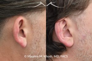 Photo of a patient before and after a procedure. Otoplasty - This gentleman was interested in ear pinning to correct over-projected ears. He underwent otoplasty under local anesthesia in our Manhattan office. He is delighted with the improved shape of his ears. 