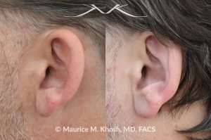 Photo of a patient before and after a procedure. Otoplasty - This gentleman was interested in ear pinning to correct over-projected ears. He underwent otoplasty under local anesthesia in our Manhattan office. He is delighted with the improved shape of his ears. 