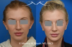 Photo of a patient before and after a procedure. Otoplasty - Otoplasty procedure, before and after photos.