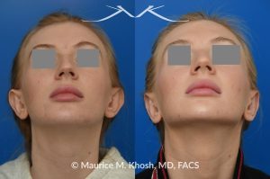 Photo of a patient before and after a procedure. Otoplasty - Otoplasty procedure, before and after photos.