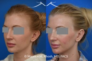 Photo of a patient before and after a procedure. Otoplasty - Otoplasty procedure, before and after photos.