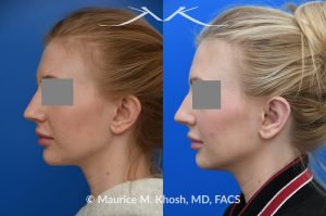 Photo of a patient before and after a procedure. Otoplasty - Otoplasty procedure, before and after photos.