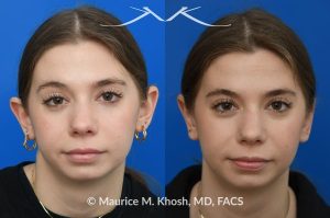 Photo of a patient before and after a procedure. Otoplasty - Ear-pinning for protubernt ears.