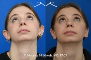 Photo of a patient before and after a procedure. Otoplasty - Ear-pinning for protubernt ears.