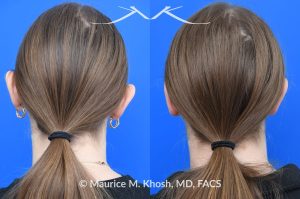 Photo of a patient before and after a procedure. Otoplasty - Ear-pinning for protubernt ears.
