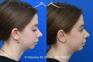 Photo of a patient before and after a procedure. Otoplasty - Ear-pinning for protubernt ears.