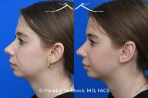 Photo of a patient before and after a procedure. Otoplasty - Ear-pinning for protubernt ears.