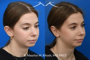 Photo of a patient before and after a procedure. Otoplasty - Ear-pinning for protubernt ears.