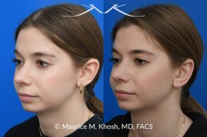 Photo of a patient before and after a procedure. Otoplasty - Ear-pinning for protubernt ears.
