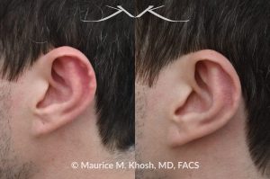 Photo of a patient before and after a procedure. Otoplasty - to fix cauliflower-wrestler's ear deromity.