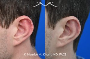 Photo of a patient before and after a procedure. Otoplasty - to fix cauliflower-wrestler's ear deromity.