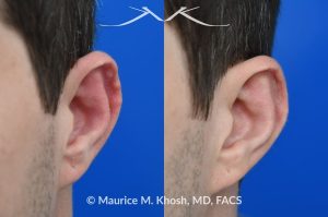 Photo of a patient before and after a procedure. Otoplasty - to fix cauliflower-wrestler's ear deromity.