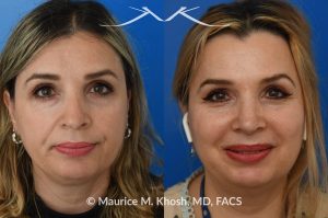 Photo of a patient before and after a procedure. Rhinoplasty for droopy and twisted tip and dorsum deviation to the right - This delightful patient wanted to address a twisted and droopy nasal tip. An open approach was used to reduce the nasal hump, elevate and refine the nasal tip. She is ecstatic with the results of her rhinoplasty. 