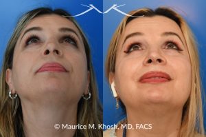 Photo of a patient before and after a procedure. Rhinoplasty for droopy and twisted tip and dorsum deviation to the right - This delightful patient wanted to address a twisted and droopy nasal tip. An open approach was used to reduce the nasal hump, elevate and refine the nasal tip. She is ecstatic with the results of her rhinoplasty. 