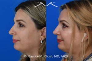 Photo of a patient before and after a procedure. Rhinoplasty for droopy and twisted tip and dorsum deviation to the right - This delightful patient wanted to address a twisted and droopy nasal tip. An open approach was used to reduce the nasal hump, elevate and refine the nasal tip. She is ecstatic with the results of her rhinoplasty. 