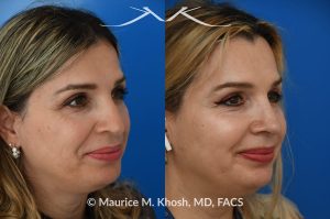 Photo of a patient before and after a procedure. Rhinoplasty for droopy and twisted tip and dorsum deviation to the right - This delightful patient wanted to address a twisted and droopy nasal tip. An open approach was used to reduce the nasal hump, elevate and refine the nasal tip. She is ecstatic with the results of her rhinoplasty. 