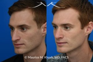 Photo of a patient before and after a procedure. Rhinoplasty for long and droopy tip and nasal hump - This young professional wanted improved breathing and enhancement of his nasal appearance. An open rhinoplasty  was used to lower the nasal bridge and narrow and elevate the nasal tip.
