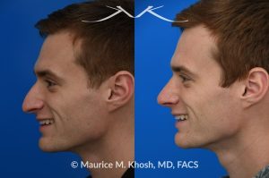 Photo of a patient before and after a procedure. Rhinoplasty for long and droopy tip and nasal hump - This young professional wanted improved breathing and enhancement of his nasal appearance. An open rhinoplasty  was used to lower the nasal bridge and narrow and elevate the nasal tip.