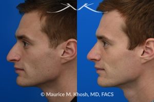 Photo of a patient before and after a procedure. Rhinoplasty for long and droopy tip and nasal hump - This young professional wanted improved breathing and enhancement of his nasal appearance. An open rhinoplasty  was used to lower the nasal bridge and narrow and elevate the nasal tip.